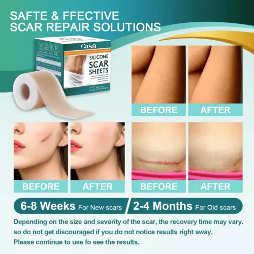Silicone Scar Sheets for Surgery & Acne Scars (Buy 1 Get 1 Free) - Image 5